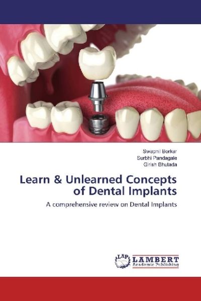 Learn & Unlearned Concepts of Dental Implants: A comprehensive review on Dental Implants - LAP Lambert Acade...